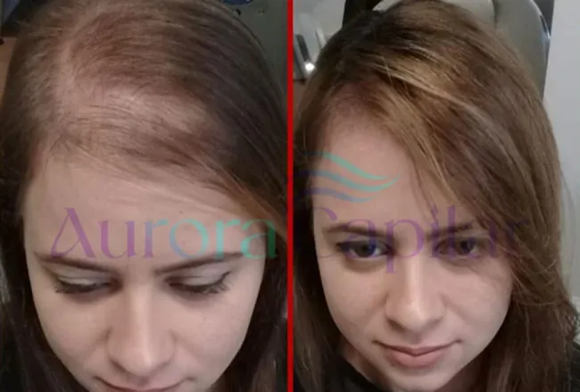 Resultado Aurora Capilar