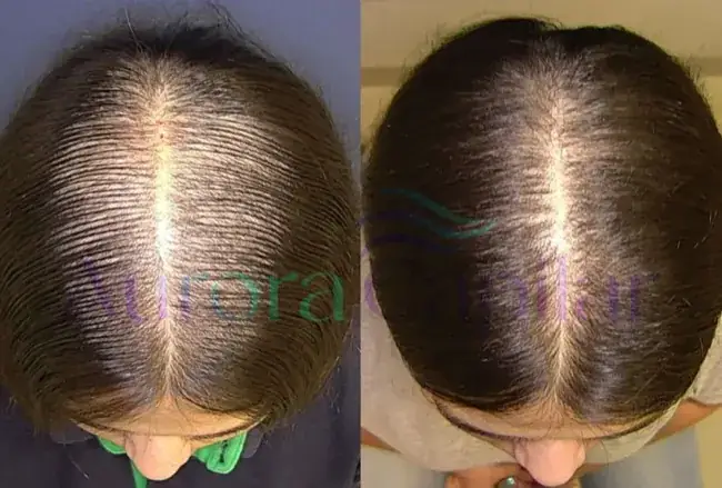 Resultado Aurora Capilar